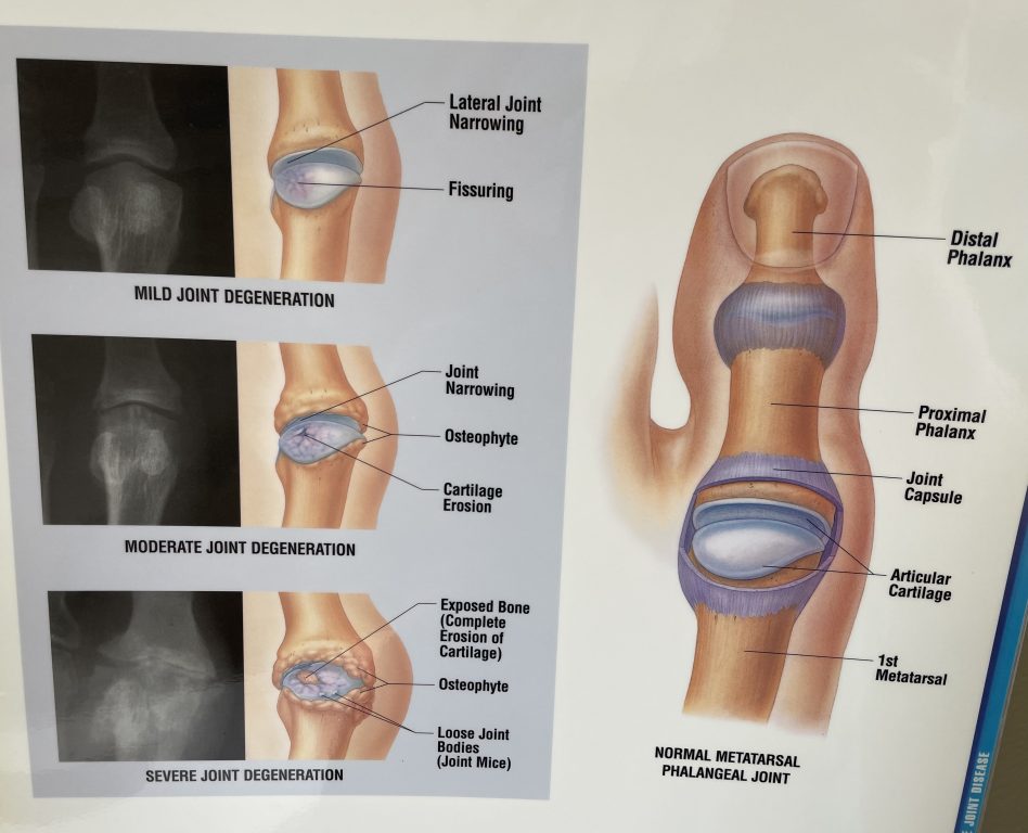 Medical illustration showing three stages of joint degeneration (mild, moderate, severe) with X-rays on the left, and labeled diagram of a normal metatarsal phalangeal joint on the right, detailing bone and cartilage structures.