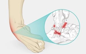 Illustration of a foot twisted inward, showing an ankle sprain. A magnified view highlights torn ligaments and inflamed areas around the ankle joint with red marks.