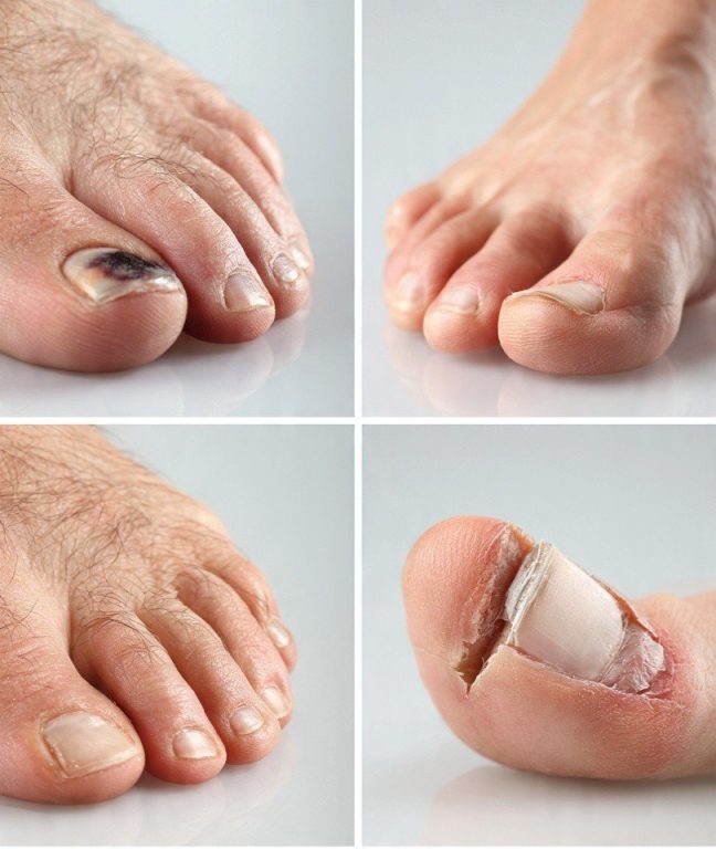 Four close-up photos of toes showing different toenail injuries: a bruised nail, a cracked nail, a partially detached nail, and a nail with visible damage and peeling.