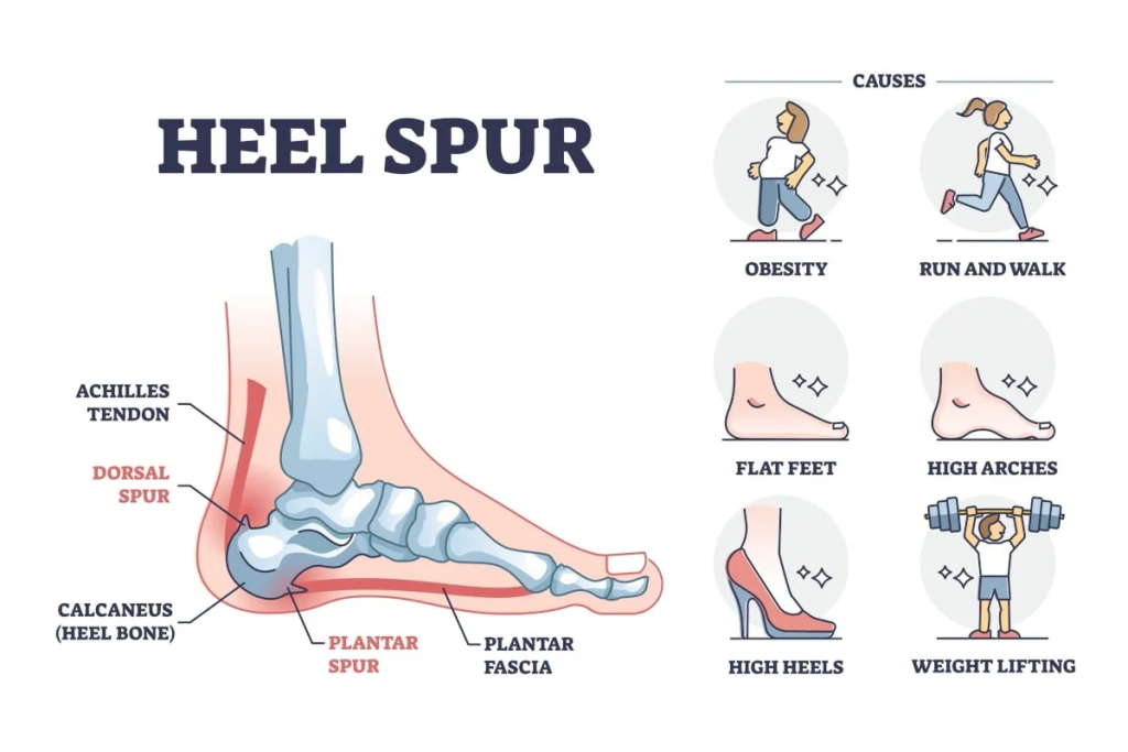 Diagram of a foot showing heel spur locations and labeled anatomy, with illustrations of causes: obesity, running/walking, flat feet, high arches, high heels, and weight lifting.
